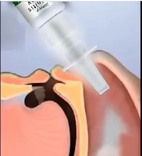 Rhinitis Care Nose Spray for People Suffering From Rhinitis Sinusitis Colds Dry Itching Swelling Nose Drops for Body Health Care 